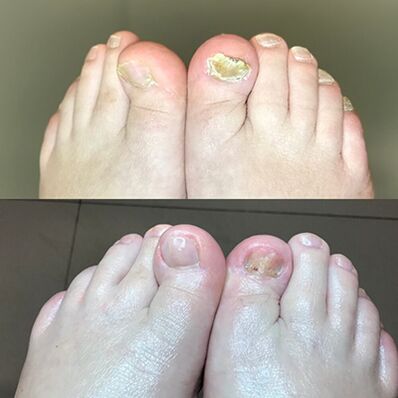 Erfahrung in der Verwendung von Israel Promic Cream Barnabas, Foto vor und nachher