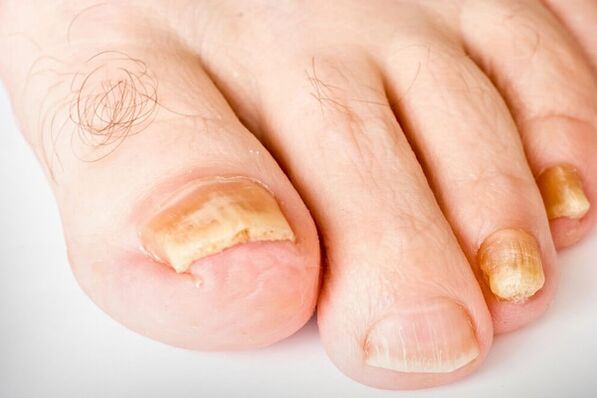 Die dritte Stufe des Hirb -Nagels
