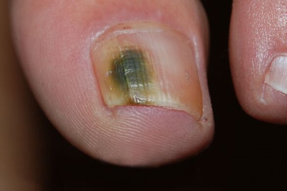 Mohose Art von Nagelpilzen