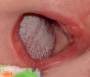 Ort der Krankheit mit einem Pilz