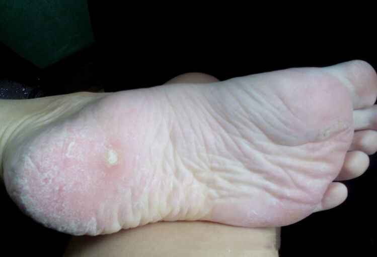 Pilzbehandlung mit einem Laser