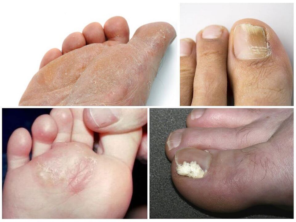 Das Anfangsstadium von Fußpilz.