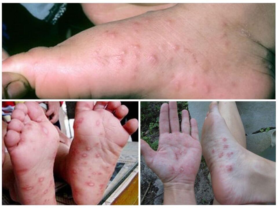 Hyperkeratotische Läsionen der Füße.