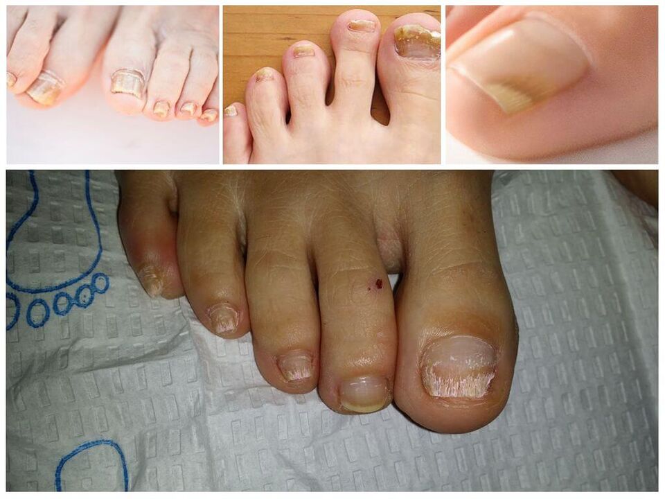 Pilzerkrankungen der Nagelplatten.