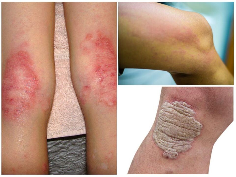 Pilzinfektionen der Knie.