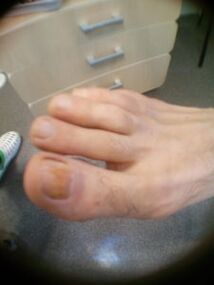 Anfangsstadium eines Nagelpilzes an der großen Zehe.