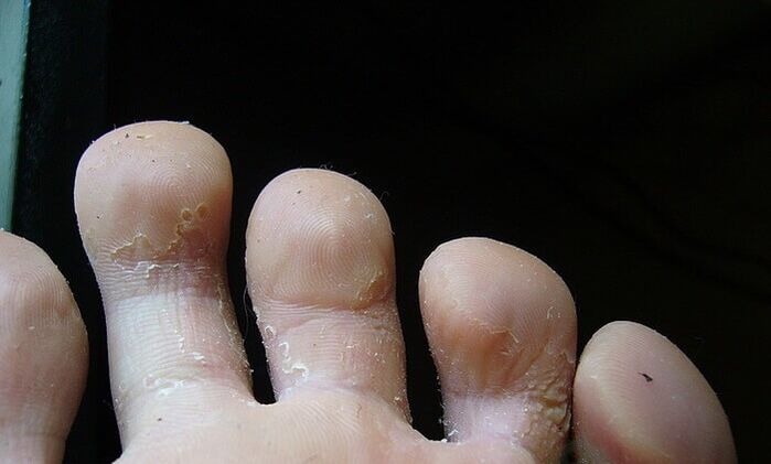 Anfangsstadium des Pilzes