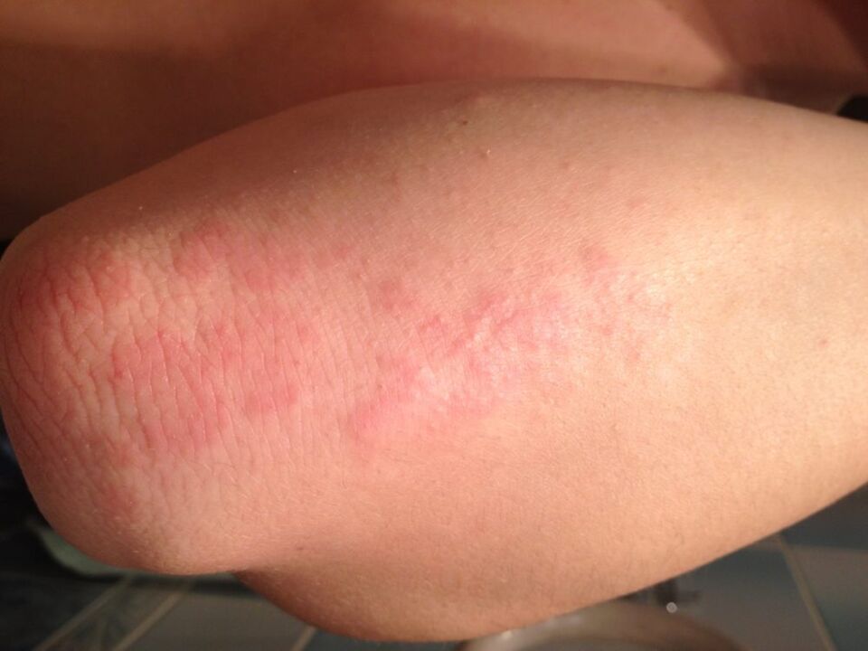 Eine allergische Reaktion in Form eines Ausschlags auf der Haut des Ellenbogens nach dem Auftragen eines Tropfens Schöllkrautsaft.